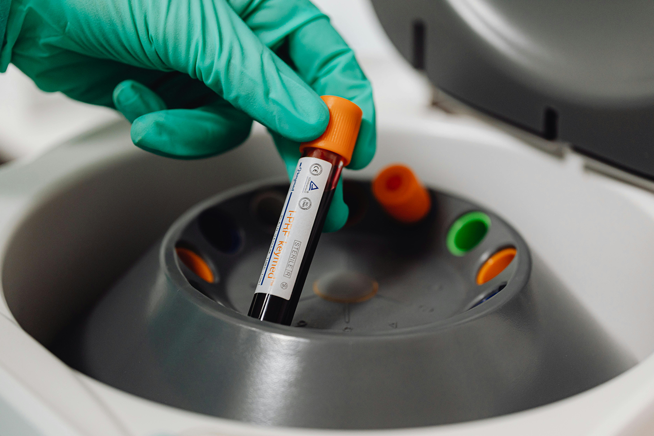 Anticorpi ABTG: un’analisi importante per la diagnosi di trombofilia e autoimmunità