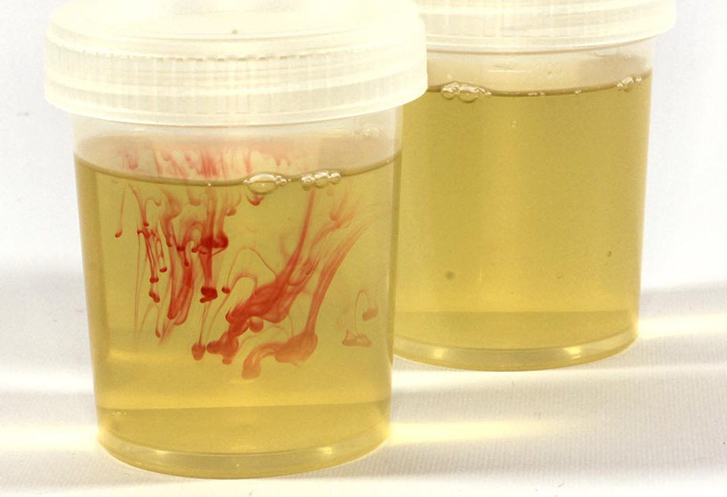 SANGUE NELLE URINE: COSA VUOL DIRE?