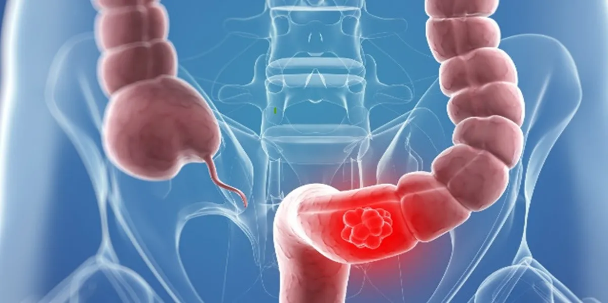 SANGUE NELLE FECI: cause, controlli e prevenzione